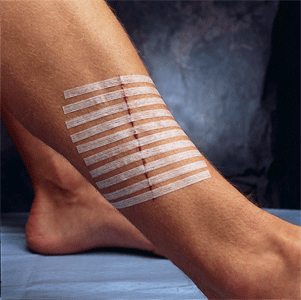 СТЕРІ-СТРІП стрічки для безшовного закриття ран 12мм*100мм, 